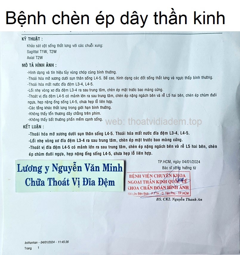 Bệnh chèn ép dây thần kinh